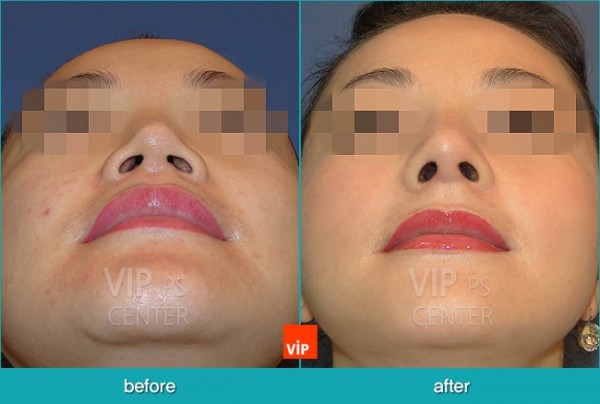 Nose Surgery - Nâng mũi bằng sụn sườn (Mũi ngắn)