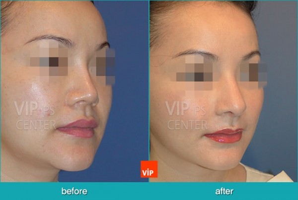 Nose Surgery - Nâng mũi bằng sụn sườn (Mũi ngắn)