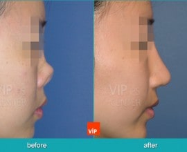 Nâng mũi bằng sụn sườn (Tái cấu trúc mũi)