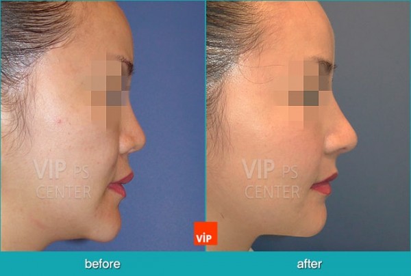 Nose Surgery - Nâng mũi bằng sụn sườn (Mũi ngắn)