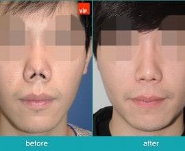 Tái phẫu thuật mũi