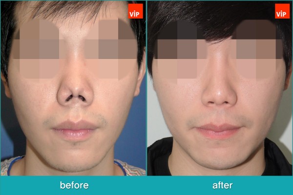 Nose Surgery - Tái phẫu thuật mũi