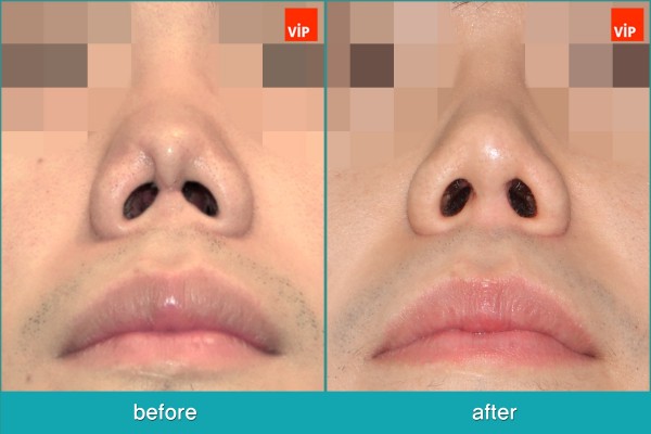 Nose Surgery - Tái phẫu thuật mũi