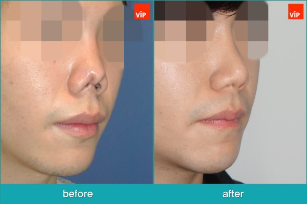 Nose Surgery - Tái phẫu thuật mũi
