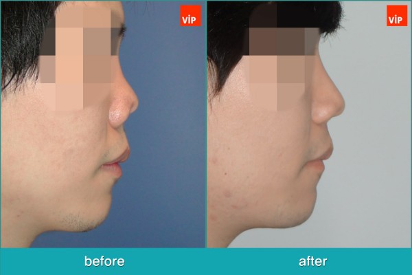 Nose Surgery - Tái phẫu thuật mũi