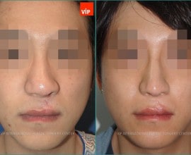 Phẫu thuật chỉnh hình mũi dị tật do sứt môi