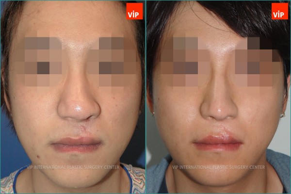 Nose Surgery - Phẫu thuật chỉnh hình mũi dị tật do sứt môi