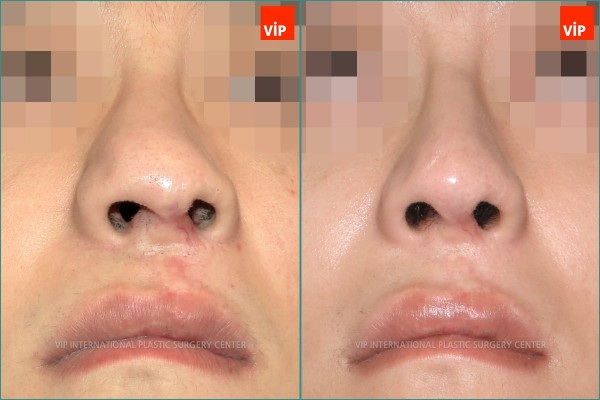 Nose Surgery - Phẫu thuật chỉnh hình mũi dị tật do sứt môi