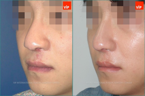 Nose Surgery - Phẫu thuật chỉnh hình mũi dị tật do sứt môi