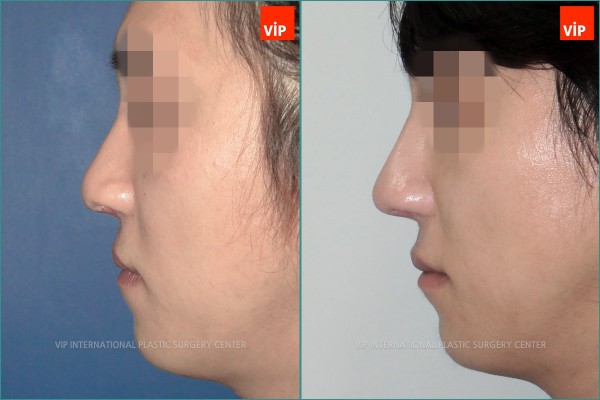 Nose Surgery - Phẫu thuật chỉnh hình mũi dị tật do sứt môi