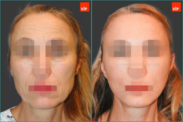 Face Lift - Căng da mặt/cổ High-SMAS