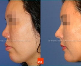Nâng mũi bằng sụn sườn