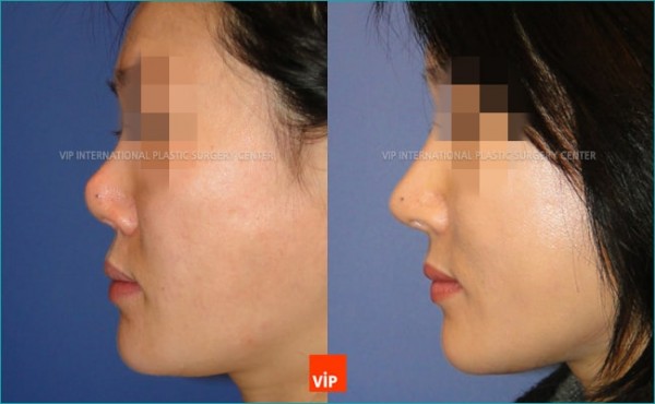 Nose Surgery - Nâng mũi hài hòa