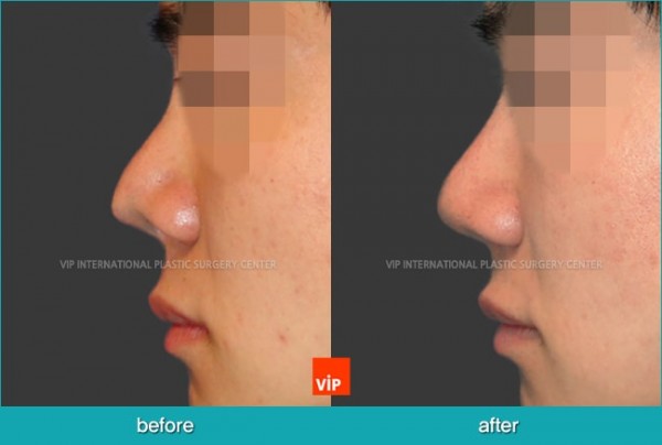 Nose Surgery - Phẫu thuật chỉnh hình mũi dị tật do sứt môi