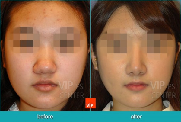 Nose Surgery - Nâng mũi hài hòa
