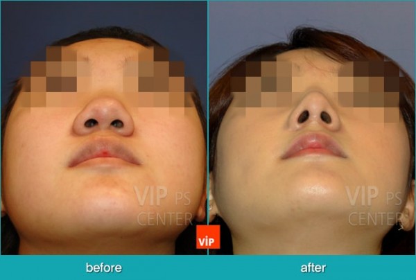 Nose Surgery - Nâng mũi hài hòa