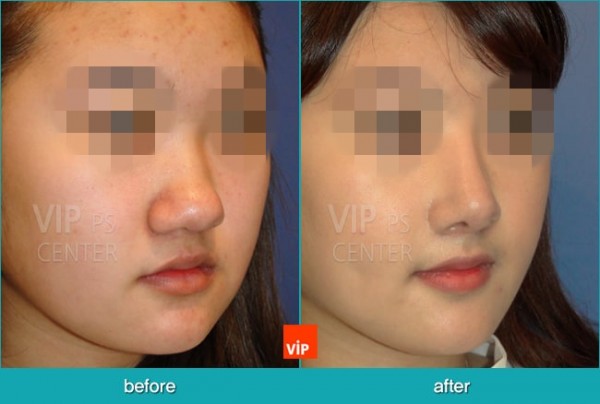 Nose Surgery - Nâng mũi hài hòa