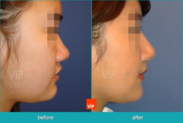 Nose Surgery - Nâng mũi hài hòa