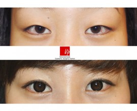 Phẫu thuật sa mí mắt