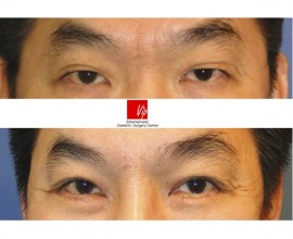 Phẫu thuật nâng trán nội soi, Phẫu thuật mí mắt trên
