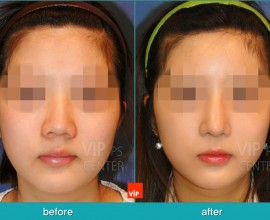 Chỉnh hình mũi lệch vách ngăn