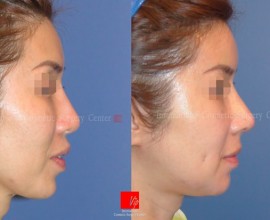 Tái phẫu thuật mũi bằng sụn sườn
