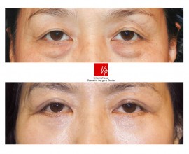 Phẫu thuật bên dưới mắt