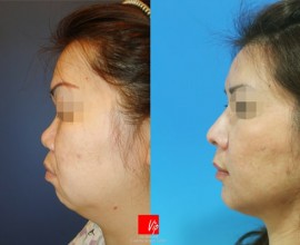 Phẫu thuật làm khuôn mặt hài hòa (Phẫu thuật nâng mũi bằng s…