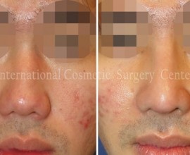 Low and deviated male nose