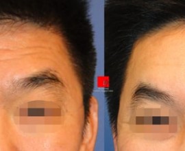 Phẫu thuật nâng trán nội soi