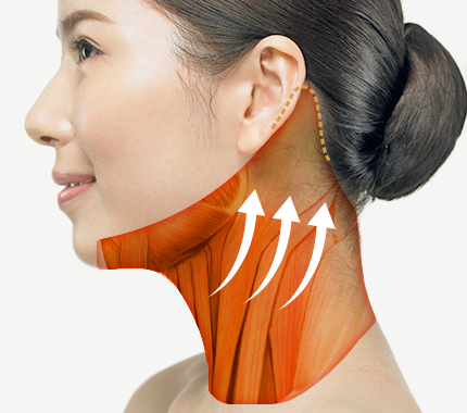 Phương pháp căng da cổ High-SMAS